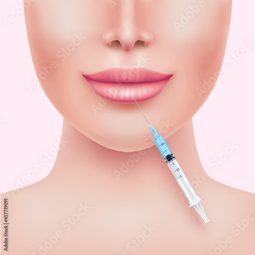 Lip enhancement filler in cosmetology. Hyaluronic acid gel. Botox injection lips. Medical and beauty concept. Realistic 3D vector EPS10 illustration.