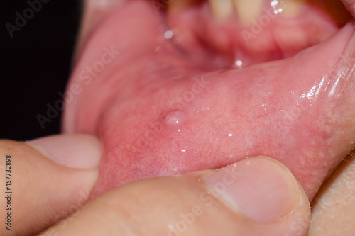Small vesicle lesion at lower lip