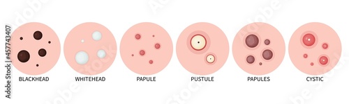 Types of acne. Acne on the skin and comedones on the face. Vector icons of acne on the skin. photo