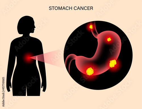 Stomach cancer anatomy