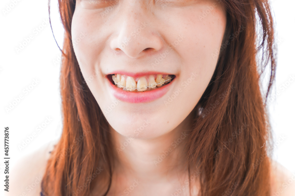 歯列矯正をする若い女性