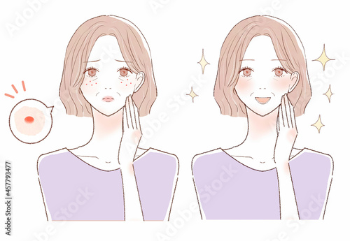 ニキビを気にする中年女性のビフォーアフター