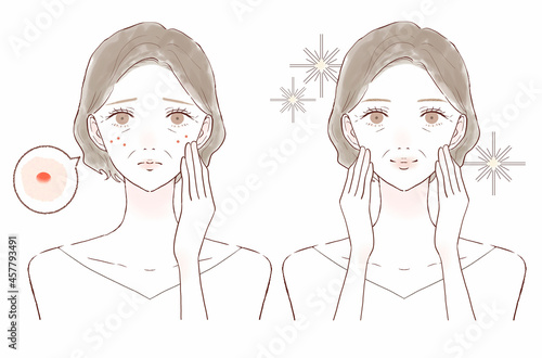 ニキビを気にする中年女性のビフォーアフター