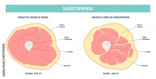 Muscle pain nerve waste injury arm leg lack diet limb nutrition body activity lateral Guillain Barre loss tissue Atrophied poor genetic older frailty Spinal gene mass Polio cord Aging adults body BMI