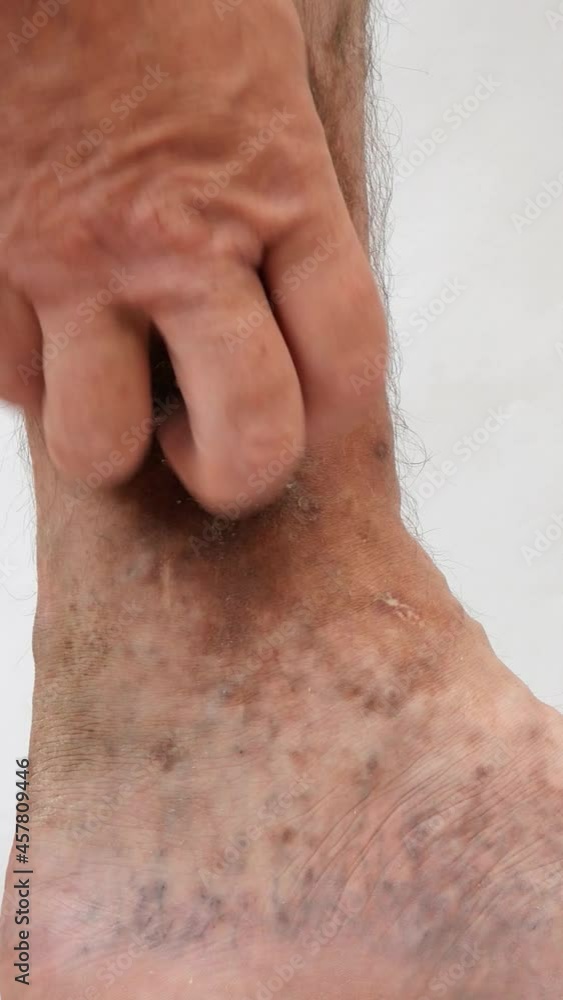 Human hands touch and crumple sore spotty leg of person suffering from blockage of veins, ulcers, dermatitis, eczema or other infectious diseases of dermatology. Close-up. Human hands touch and crumple sore spotty leg of person suffering from blockage of veins, ulcers, dermatitis, eczema or other infectious diseases of dermatology. Close-up.