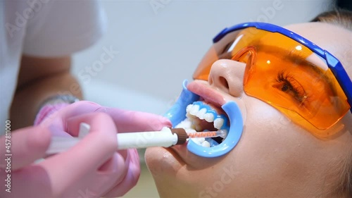 Doctor Applies Whitening Gel To Patient's Teeth. Teeth Whitening In a Dental Office. Healthcare And Medicine Concept. Slow Motion Effect. Close Up