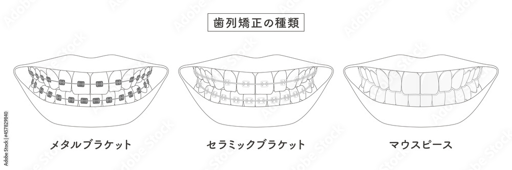 歯列矯正の種類 セットイラスト 歯列矯正の種類 セットイラスト