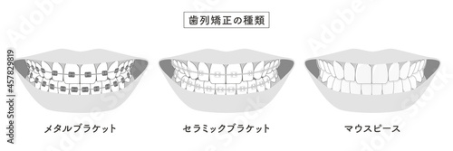 歯列矯正の種類　セットイラスト