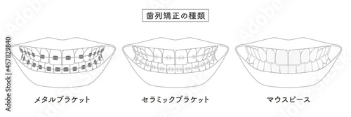 歯列矯正の種類　セットイラスト