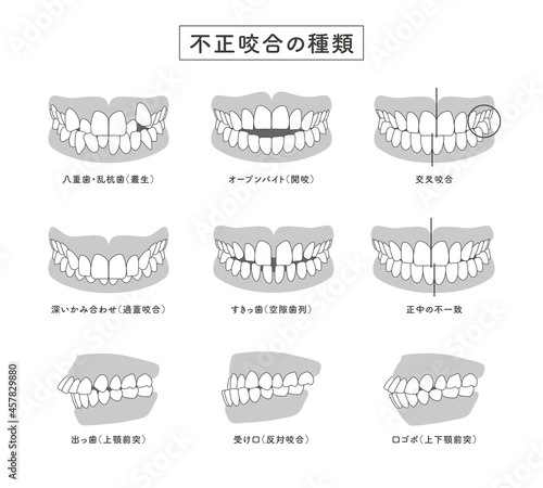 不正咬合の種類　セットイラスト
