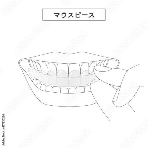 マウスピースを装着するイラスト