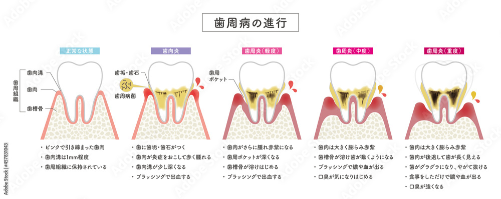 歯周病の進行 Stock ベクター Adobe Stock