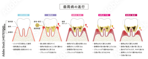 歯周病の進行