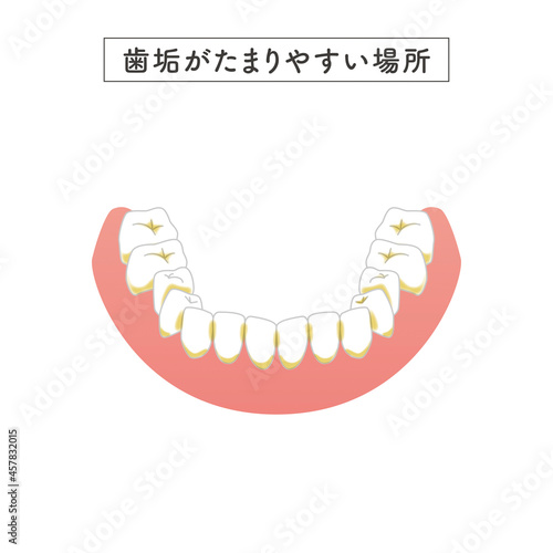 磨き残ししやすい場所のイラスト