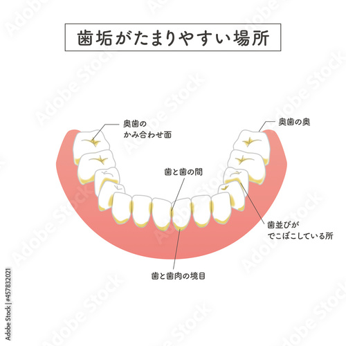 歯垢が溜まりやすい場所のイラスト