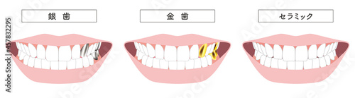 金歯　銀歯　セラミックのイラスト
