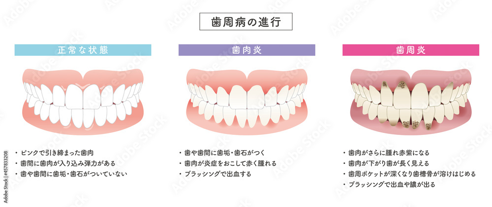 歯周病の進行 イラストセット Stock Vector Adobe Stock