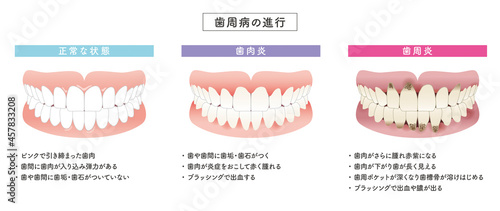歯周病の進行　イラストセット