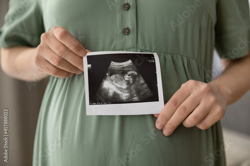 Fotografia Prenatal ultrasound screening