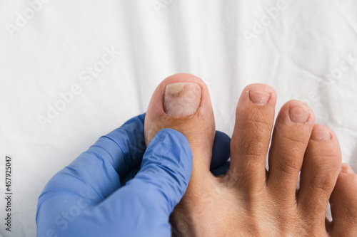 A podologist examines bare foot with onycholysis on a toenail after damaging with tight shoes or using gel-lacquer photo