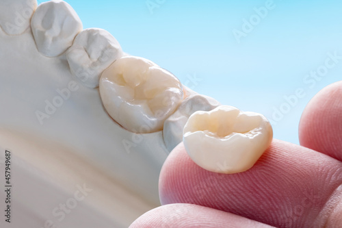 Closeup / Prosthodontics or Prosthetic / Single teeth crown and bridge equipment model express fix restoration. photo