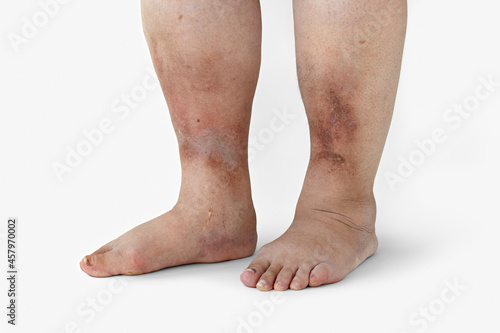 Inflamed legs of a woman with diabetes, close-up