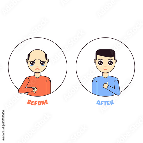 Male cartoon character vector illustration with hair loss problem. Happy man with thumb up after alopecia treatment. Health problem concept.