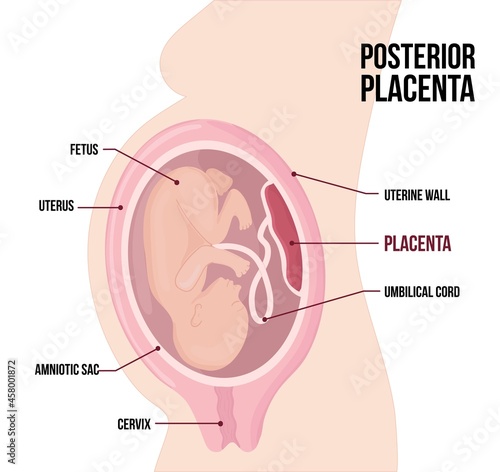 Posterior Placental previa. Usual anatomical Placenta Location During Pregnancy.