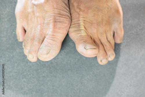 Skin Dry and rough feet and toenail of older people
