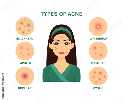 Beautiful Young Woman and Types of Acne. Isolated Teenager Girl with a Bad Problem Skin of Face. Infection, Rash and Redness on Female Character. Illustration for Cosmetology, Medical Design. Vector