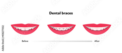 Dental teeth braces before and after infographic. Vector flat healthcare illustration set. Smile mouth with tooth and brace isolated on white background. Design for health care poster.