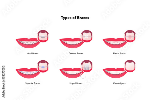 Dental teeth braces types infographic. Vector flat healthcare illustration set. Smile mouth with tooth. Different type of brace isolated on white background.