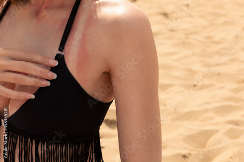 Sunburn on the shoulder and neck of a young woman at the beach. Female wearing a bikini showing her red tan lines and damaged skin from the sun due to lack of uv, sun screen protection