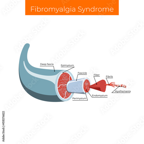 Vector illustration. Fibromyalgia syndrome, widespread musculoskeletal pain accompanied by fatigue