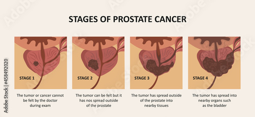 Stages of prostate cancer. The tumor grows and penetrates into organs and tissues.