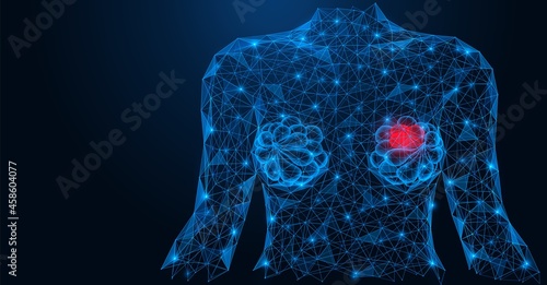 Inflammation of the breast in women. Female breasts with signs of the disease. A low-poly construction of interconnected lines and points. Blue background.