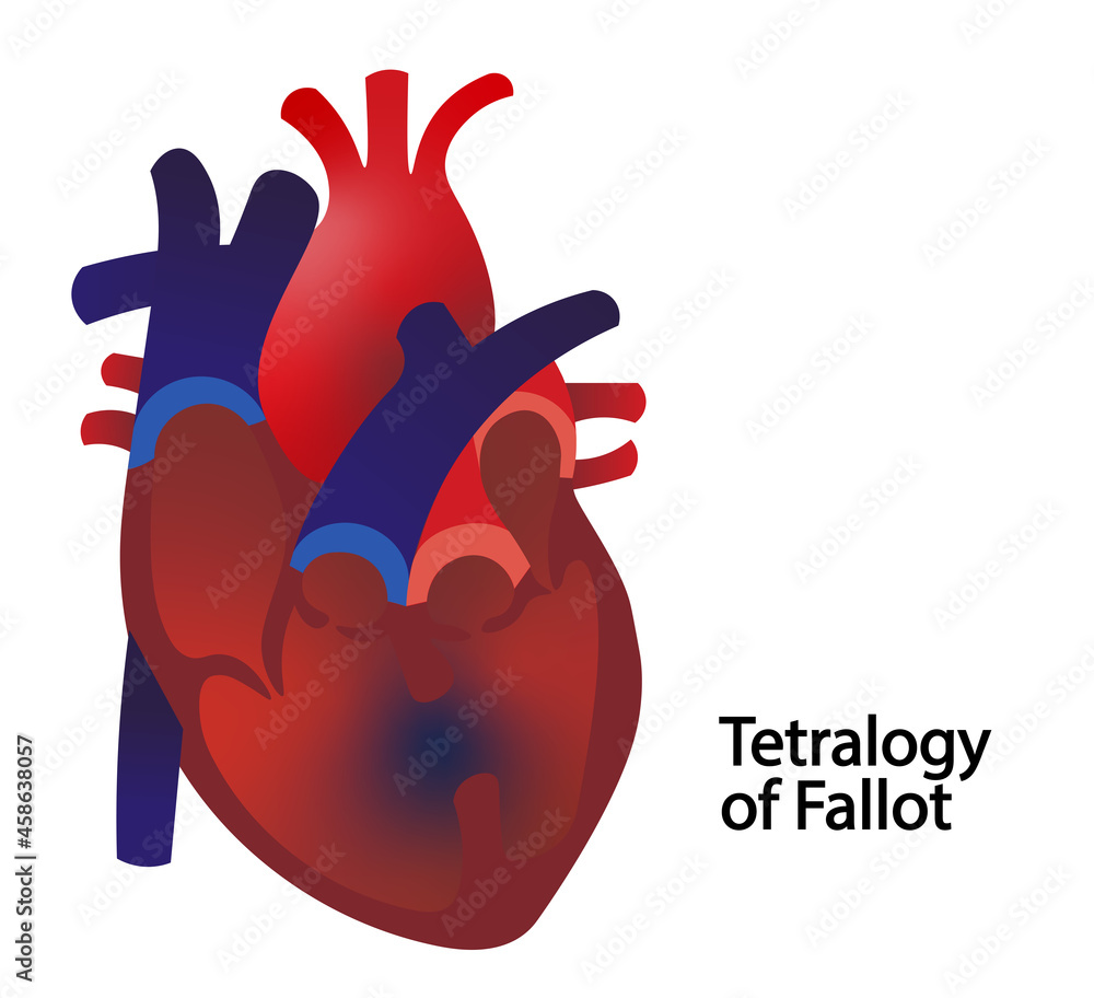 Tetralogy of fallot disease.
Congenital heart disease Tetralogy of fallot disease.
Congenital heart disease
