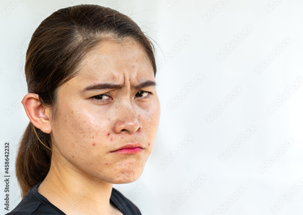 Obraz premium Asian woman having stress because of problems of acne inflamed on her face. Inflamed acne consists of swelling, redness, and pores that are deeply clogged with bacteria, oil, and dead skin cells.