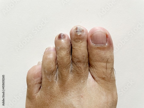 Injury, purple toenails caused by wearing shoes for a long time, wearing running shoes that are too small can cause purple toenails.