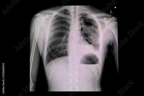 Xray chest of a patin with ICD photo