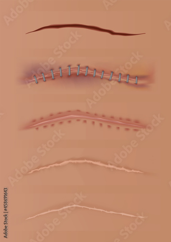 Set of healing wounds, skin scars, stitched gash and cuts. Realistic surgical sutures, stitched wounds at different healing stages. Collection of ruptures in body tissue