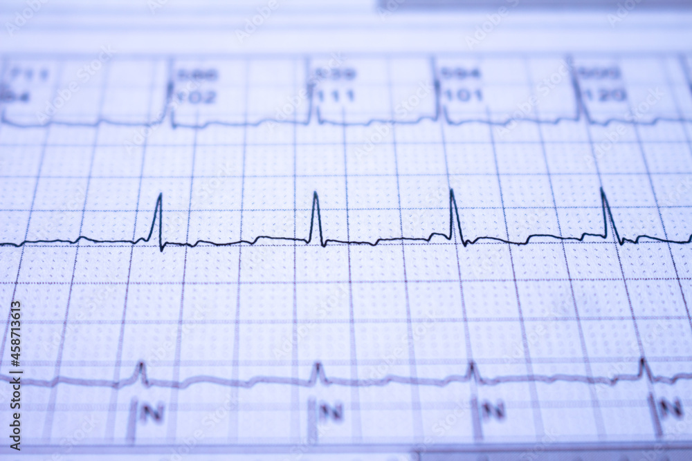 Electrocardiogram with cardiac arrhythmia. Atrial fibrillation recorded as the origin of many cerebrovascular accidents or strokes. Electrocardiogram with cardiac arrhythmia. Atrial fibrillation recorded as the origin of many cerebrovascular accidents or strokes.