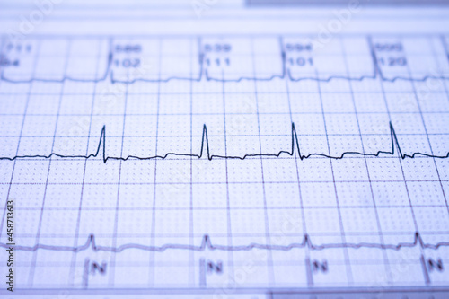 Electrocardiogram with cardiac arrhythmia. Atrial fibrillation recorded as the origin of many cerebrovascular accidents or strokes. photo