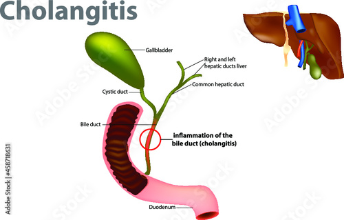 Ascending cholangitis, also known as acute cholangitis or simply cholangitis, is inflammation of the bile duct. Obstruction of the bile duct photo