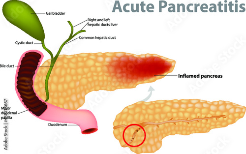 Acute Pancreatitis caused by gallstone. Gallstones block the flow of pancreatic juices into the duodenum. photo