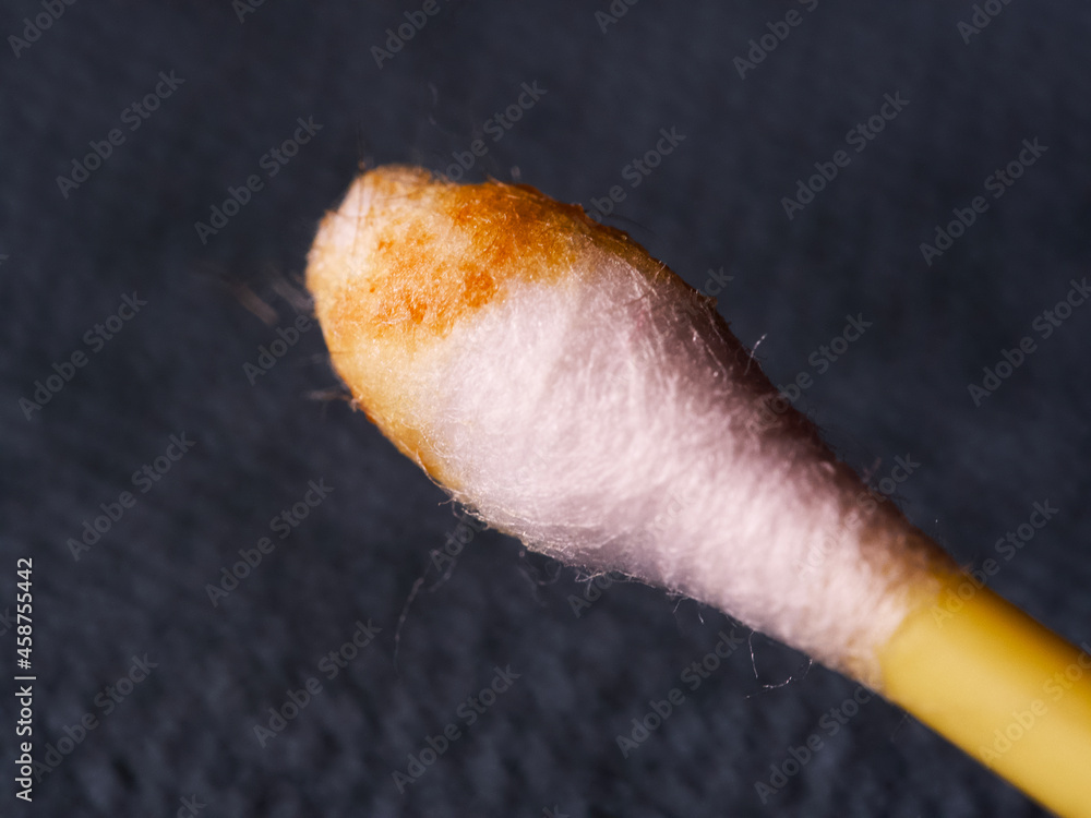 Earwax on a cotton swab, macro photo. Earwax, also known by the medical