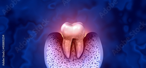 Tableau sur toile Tooth Decay Disease