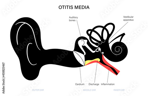 otitis media disease