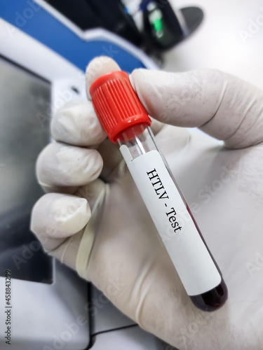 Blood sample for HTLV(Human T-lymphotropic virus) test, used to detect an infection by HTLV-I or HTLV-II photo