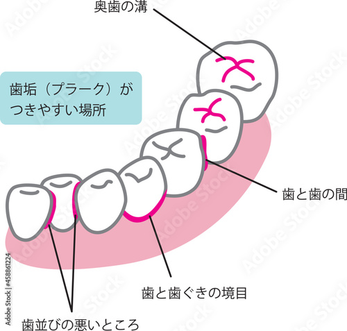 プラークが付きやすい場所